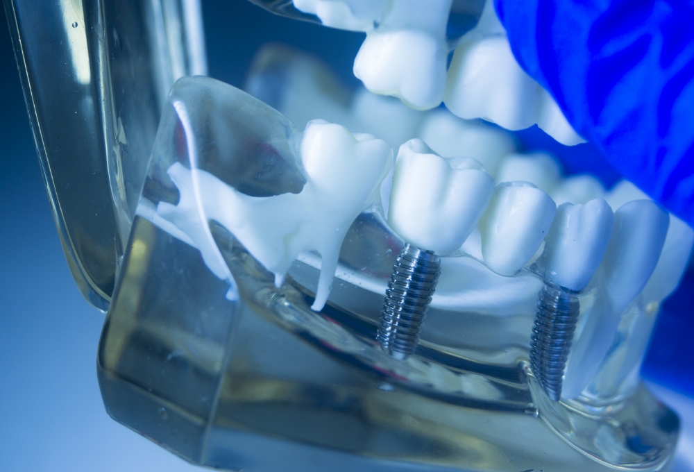 インプラントとは