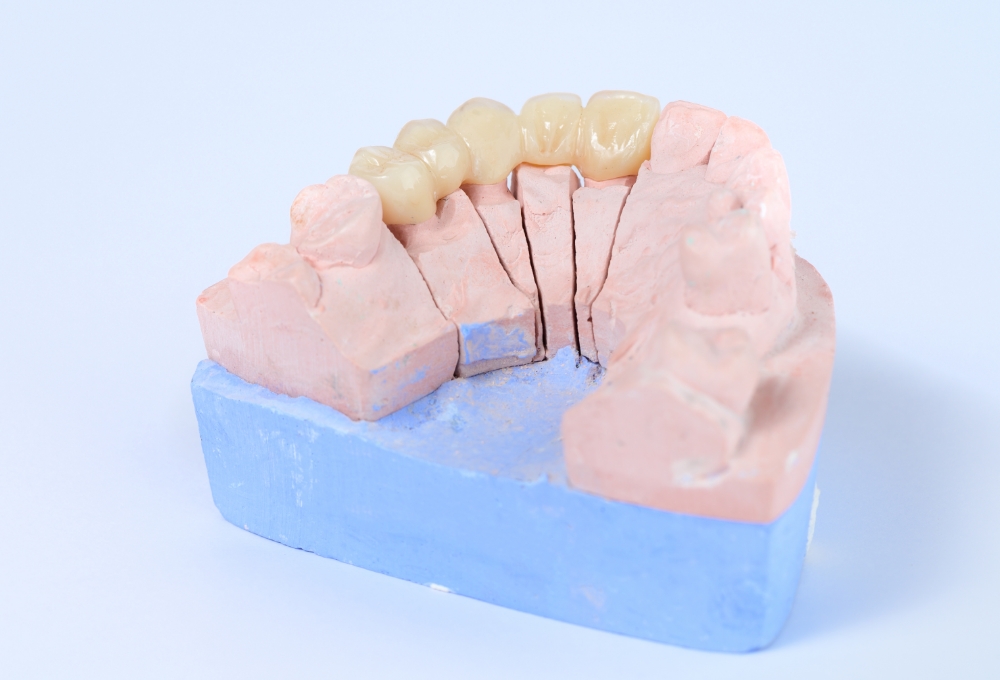 セラミック治療